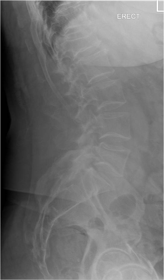 This 69 year-old male patient presented to a chiropractor with acute onset low back pain. He has a history of prostate cancer dating back to 2015. The patient had received 3 adjustments before x-rays were available, and he reports that his pain is lessening with care. 